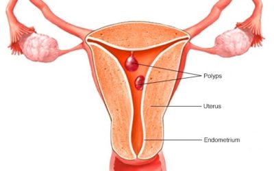 Can I get rid of my uterine polyps without surgery?