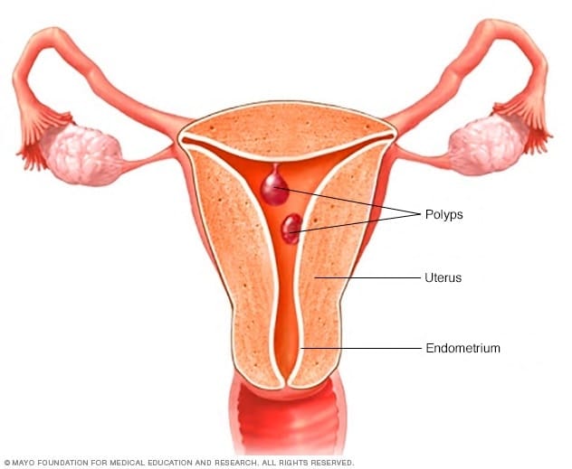 Can I get rid of my uterine polyps without surgery?